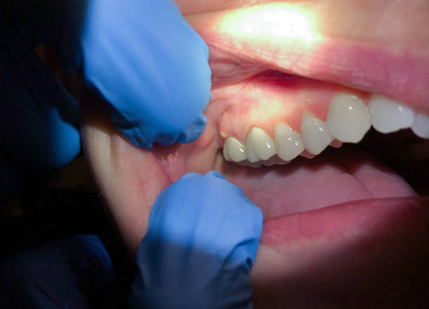 Best Broken or Cracked Tooth Emergency Dentist in Steelville, MO
